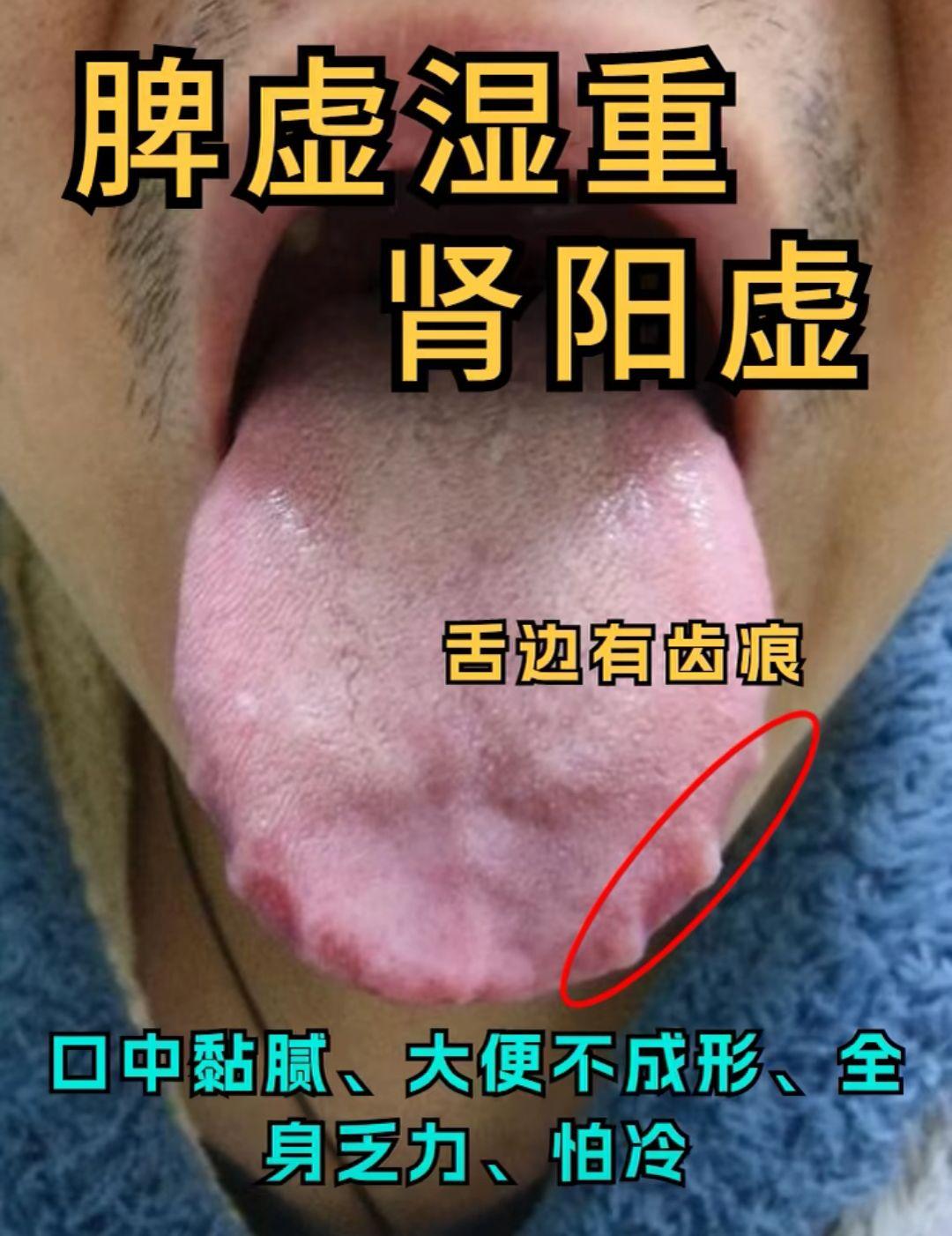 脾胃虚弱 该怎么办 看看舌象分析再定论