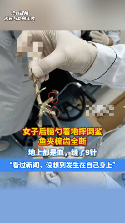 鲨鱼夹摔碎致头皮受伤，9针缝合引警惕……
 
河南信阳一女子散步时，用鲨鱼夹挽着