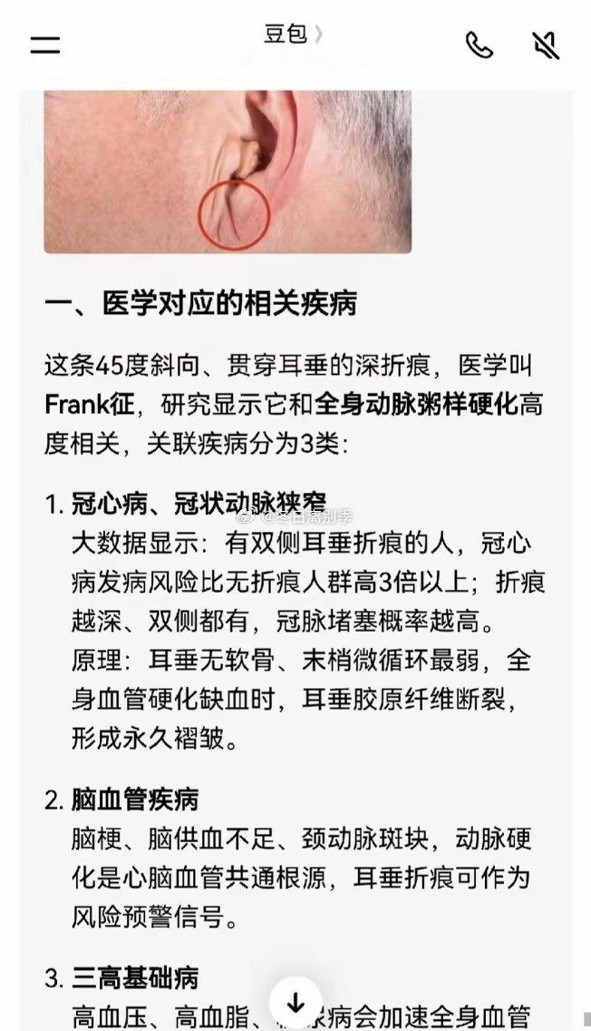 才注意到周星驰耳垂部位的深折痕，据悉这和全身动脉粥样硬化高度相关，所以这就是他多