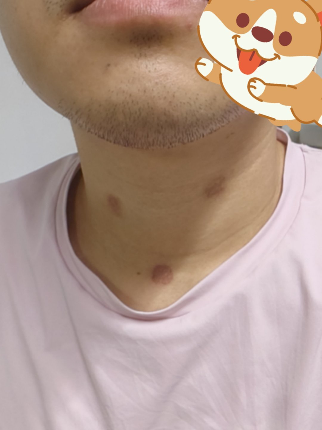 三伏贴把我烧的…直接被问是不是种草莓🍓 ​​​