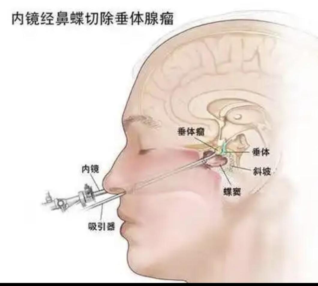 你知道吗？现在切除脑部的垂体瘤，可以从鼻孔里“走”。本周完成两台“经鼻...
