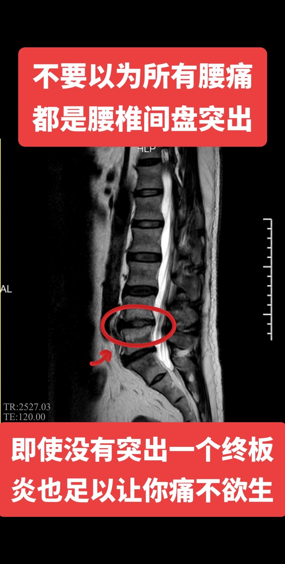 大家都在关注腰椎间盘突出，即使腰椎间盘突出不严重，一个终板炎也足以让你痛不欲生