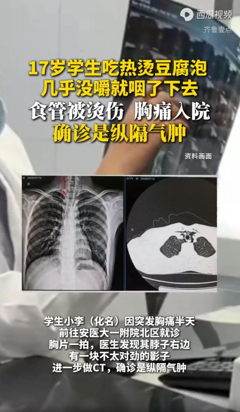万万没想到！安徽，一名 17 岁学生吃热豆腐泡，因为入嘴嫌热，他直接就给吞下去，