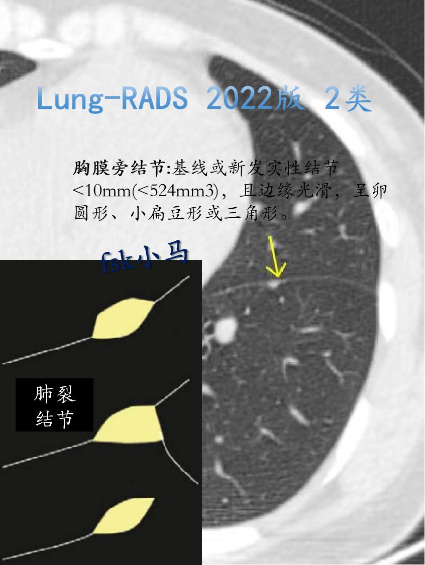 Lung-RADS 2022版 2类：良性，群体罹患率45%。表现:胸...