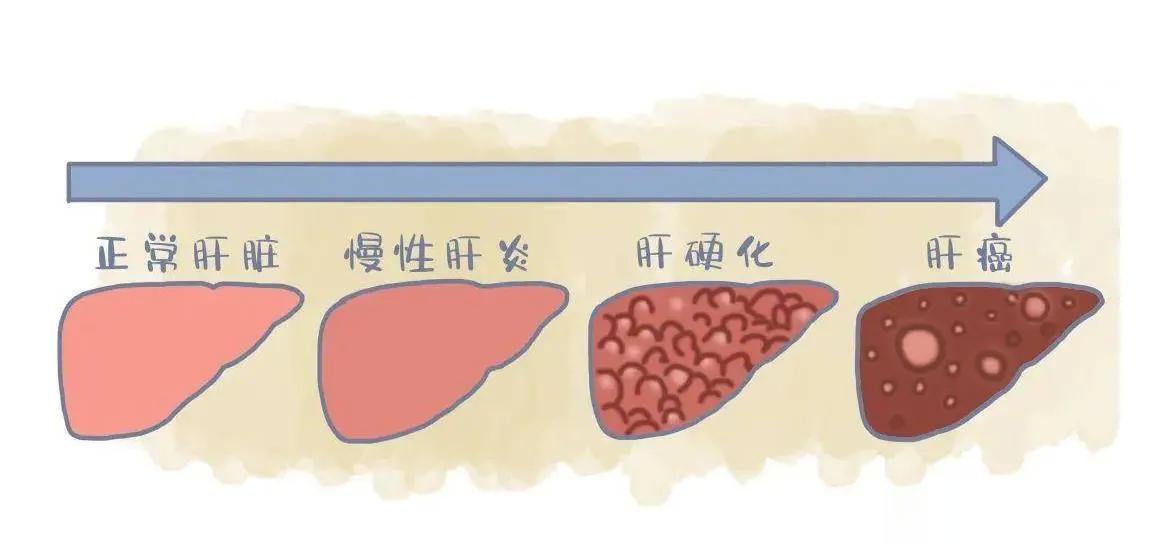 肝硬化合并肝癌有哪些表现？ 第一，肝区疼痛，这是最常见的症状，疼痛有时候是间歇性