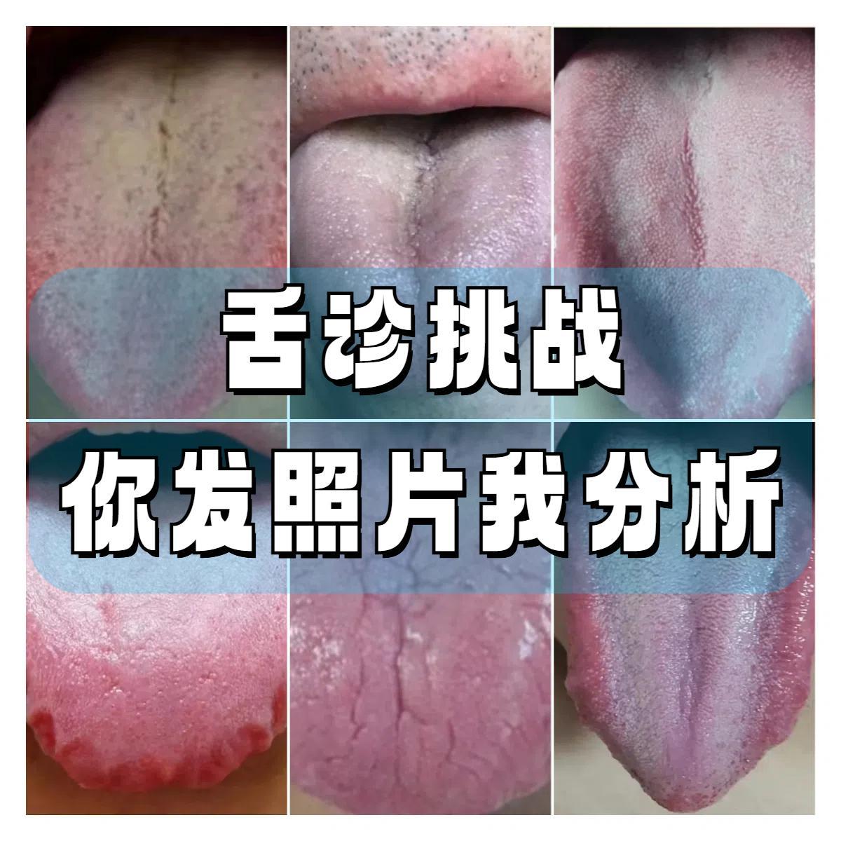 今日舌诊——看完80个舌象！
#舌诊##中医#