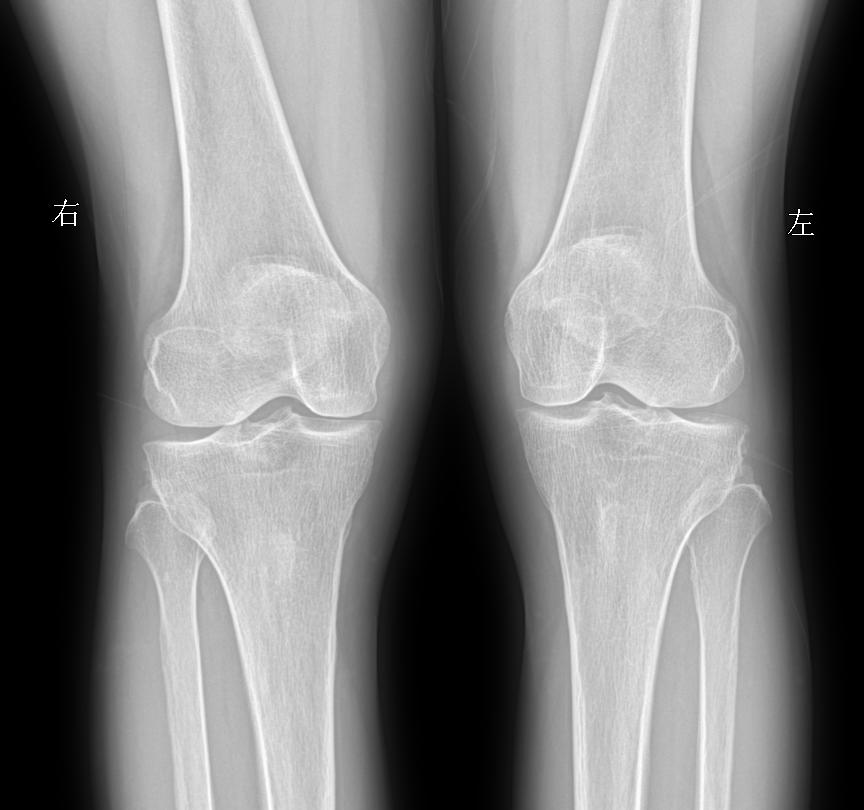 老师们拍摄膝关节采取站立位还是卧位