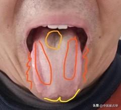 舌诊实战分享：
病人主诉：白发多，房事也短，口臭
舌象分析：
舌质：颜色淡白，提