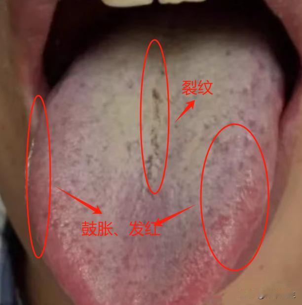 这样的裂纹舌根本不是脾的事，吃什么根本没用，病根在肝上
先看这位患者的舌头，舌中