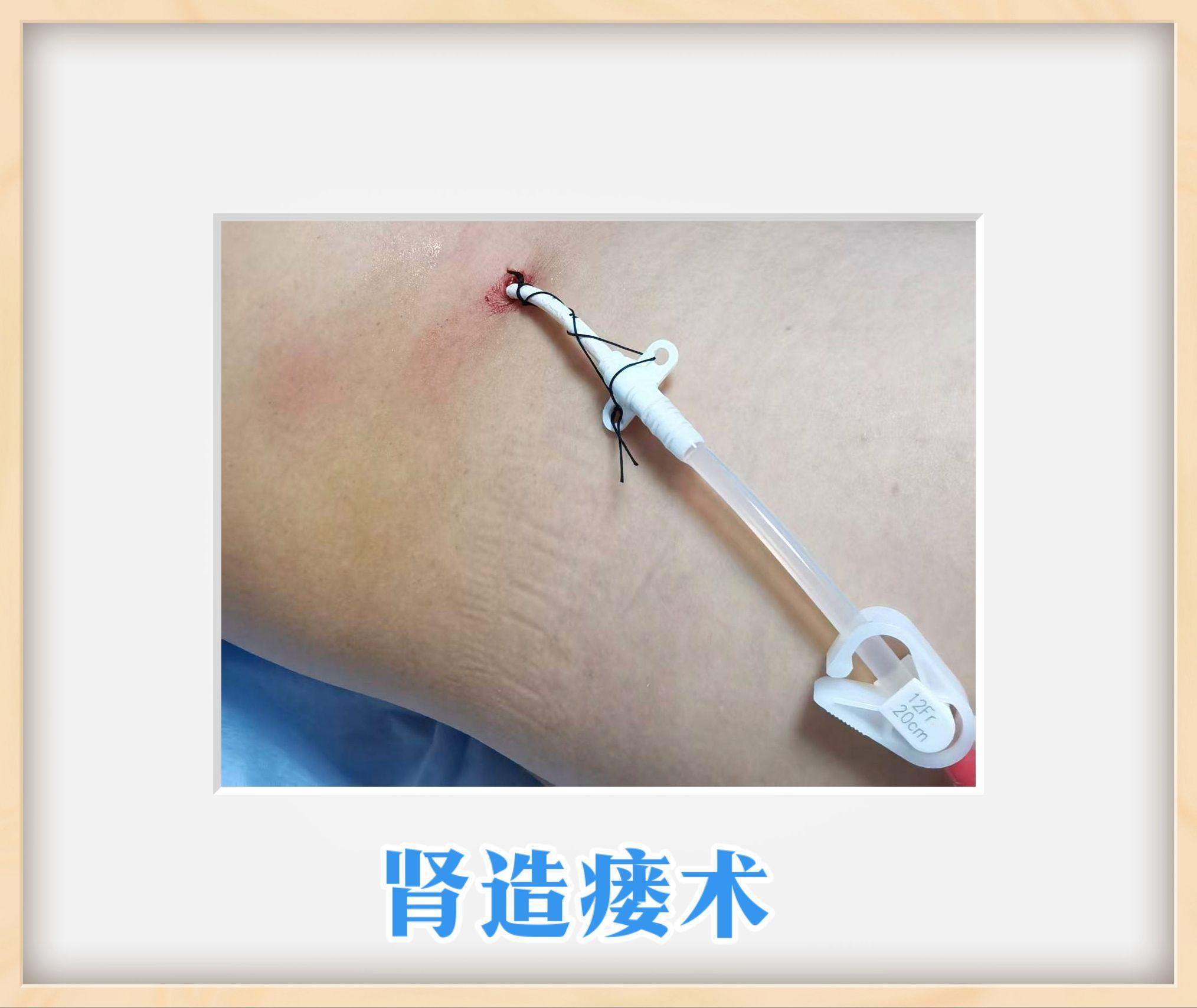肾造瘘术:为肾脏开辟生命新通道！一道小口，一份希望。 面对疾病的挑战...