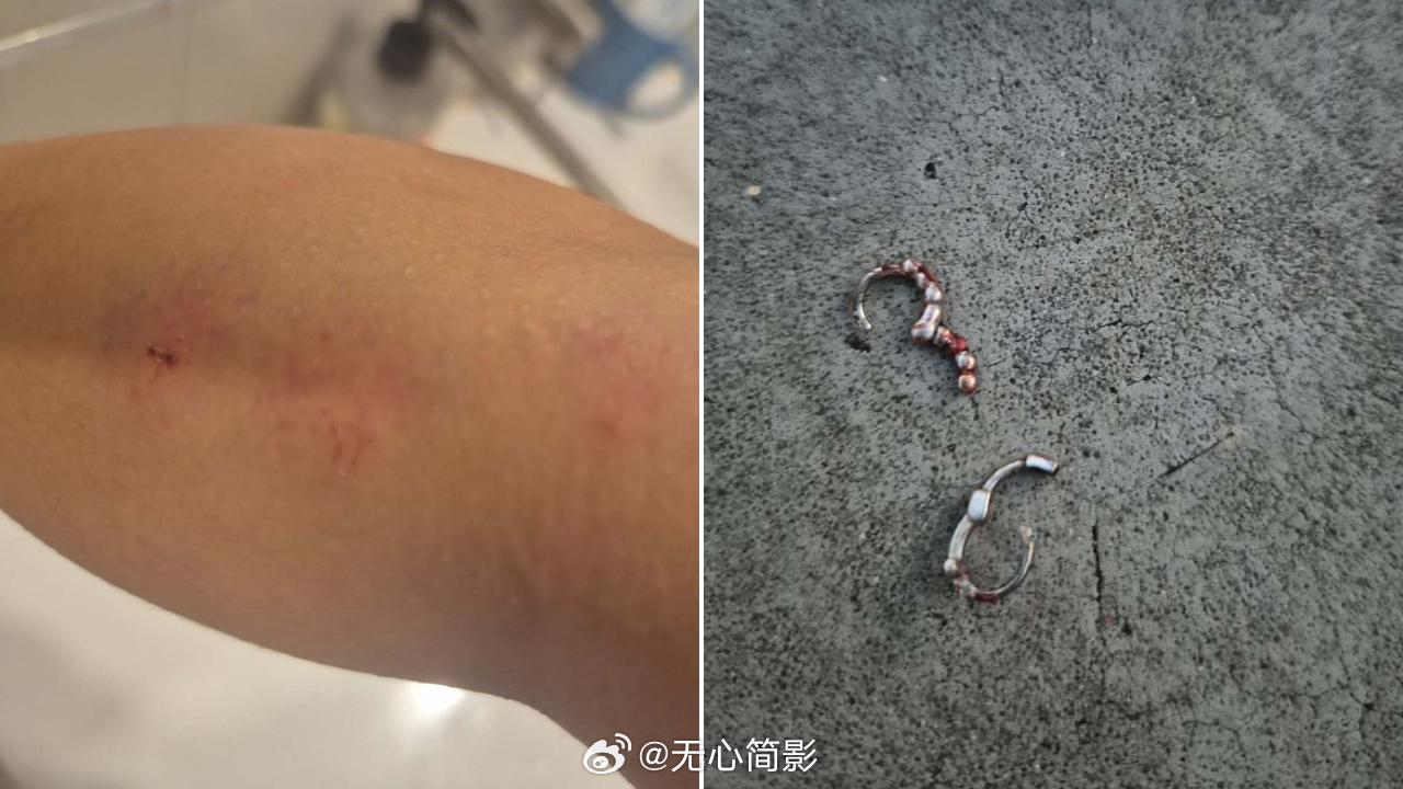 一名中国女性在澳大利亚首都遭种族辱骂后遇袭，浑身是血被送医治疗。这名 27 岁女