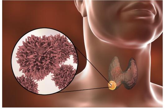最新美国ATA甲状腺癌动态监测推荐力度加强