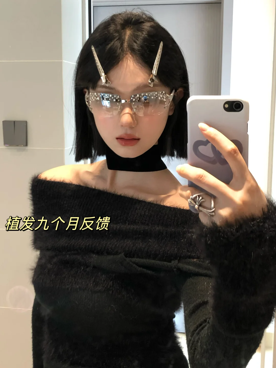 植发九个月｜完全是主人级别