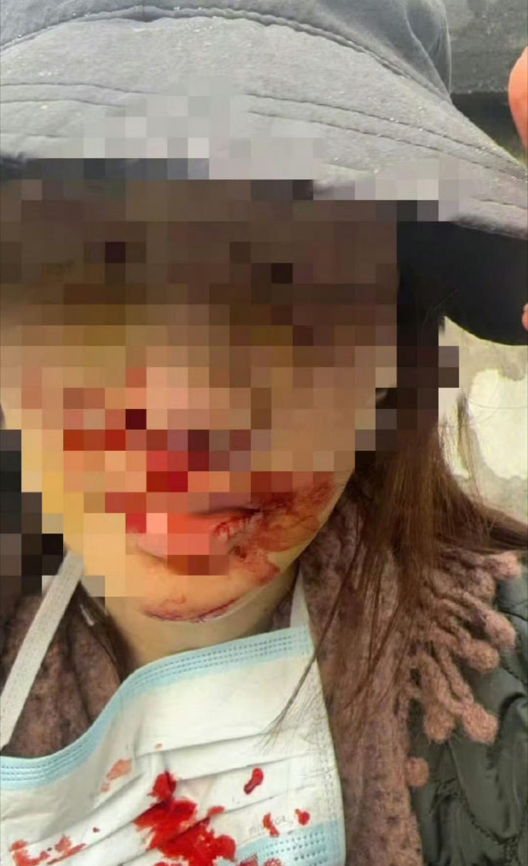 总感觉金晨事件被狗仔曝光出来有点蹊跷，一年多前的事，当时的确她的确受伤严重，唯一