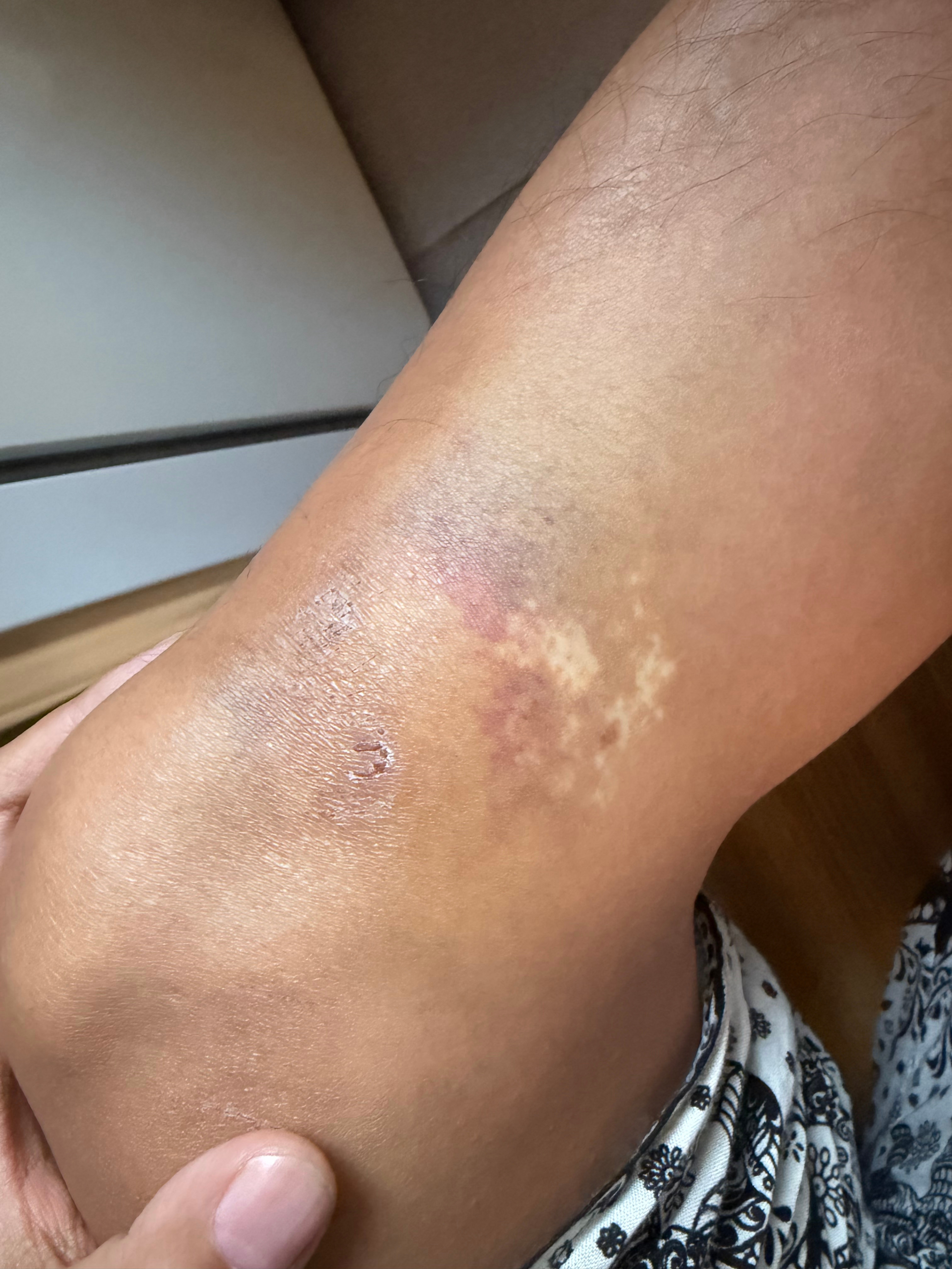 呜呜呜，膝盖还是紫的，摔得好重…… 