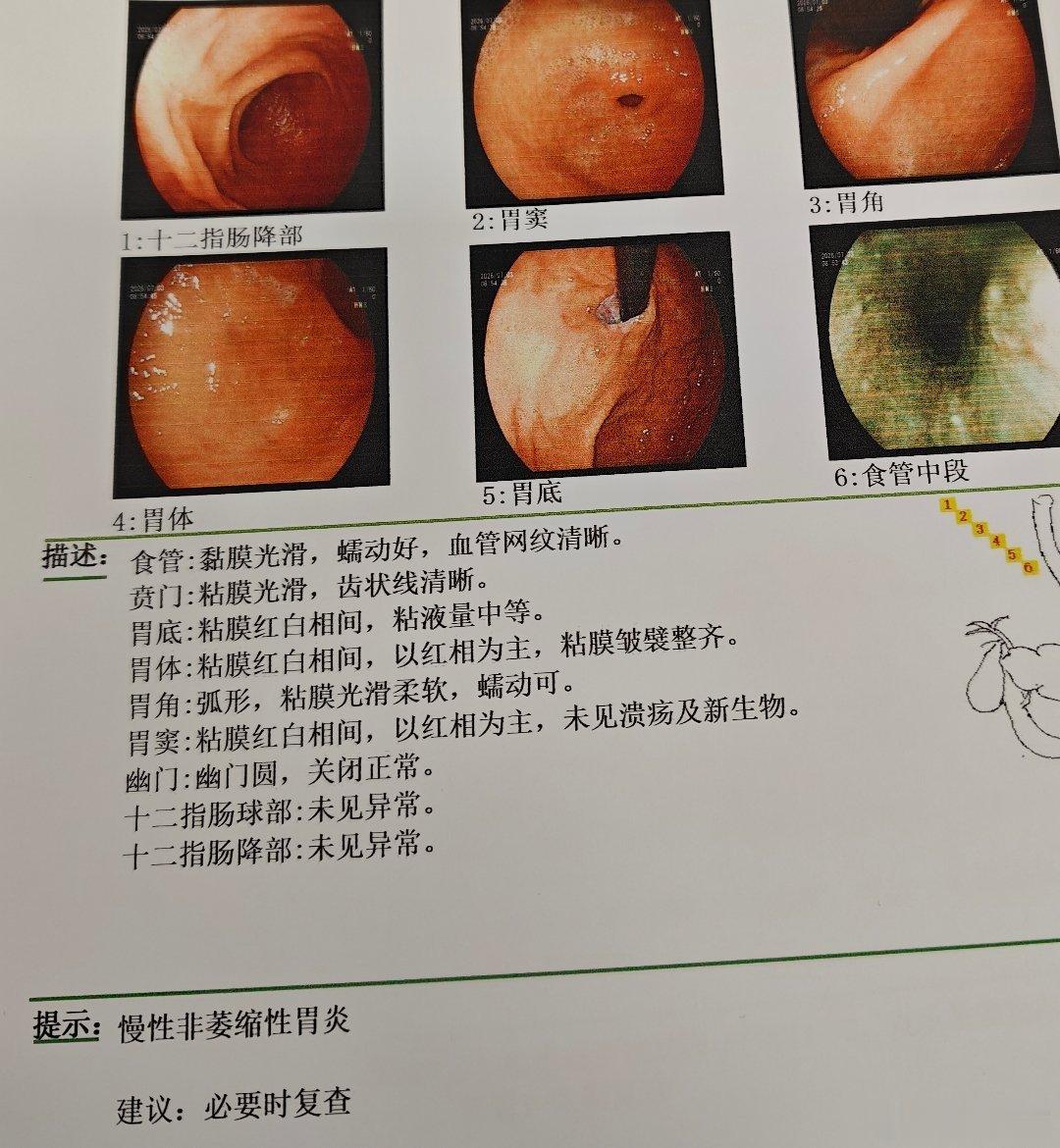 病理 Ki‑67一、基础定义Ki‑67是细胞增殖指数，只在分裂活跃的细胞核表达，