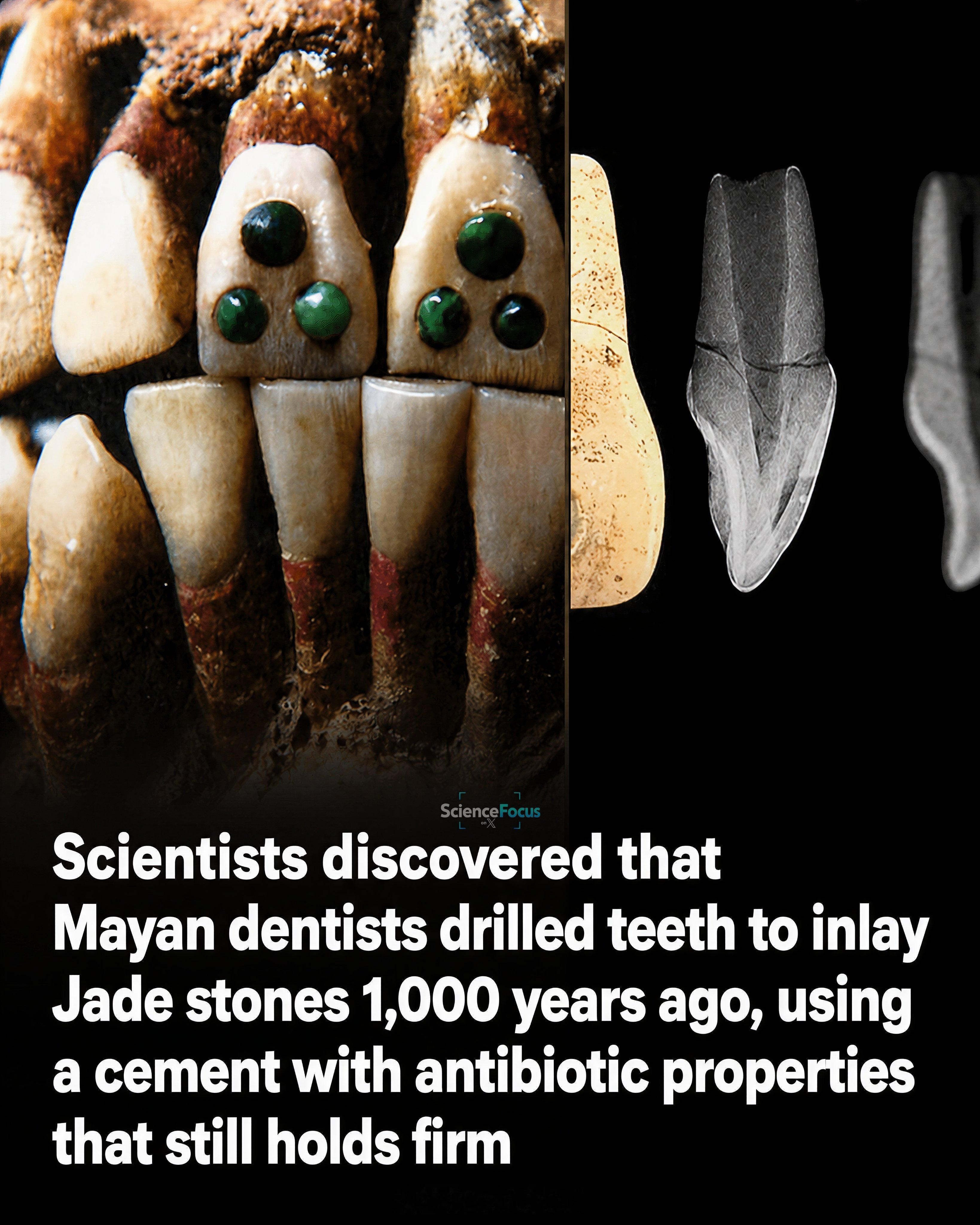 1000年前玛雅牙医给人门牙上镶嵌的玉石至今仍然牢固玛雅 牙医 世界历史