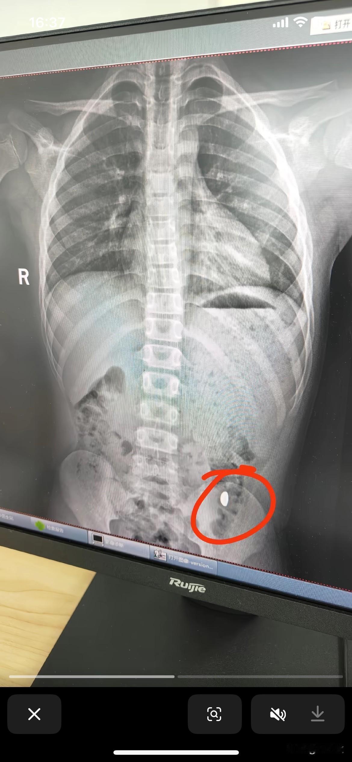 男孩误吞金豆后续，
六天后金豆终于排出来了，网友都很好奇一个11岁的男孩为什么会