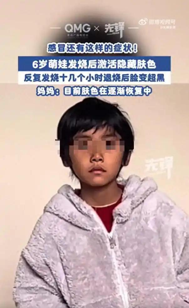 6岁男童高烧后脸变黑，背后真相是什么？
近日，湖南衡阳的一名6岁男孩因高烧40度