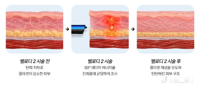 韩国高端圈都在玩儿的吸脂修复神器Velody真的夯爆了，是那种侵入式激光，专门针