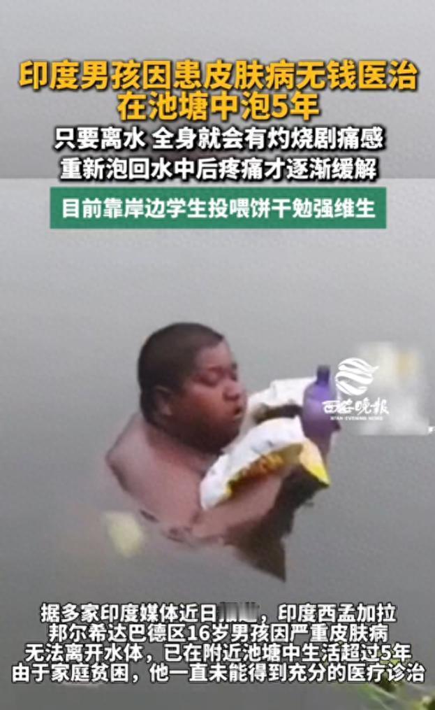 印度男孩因患皮肤病无钱医治，在池塘中泡 5 年，只要离水，全身就会有灼烧剧痛感，