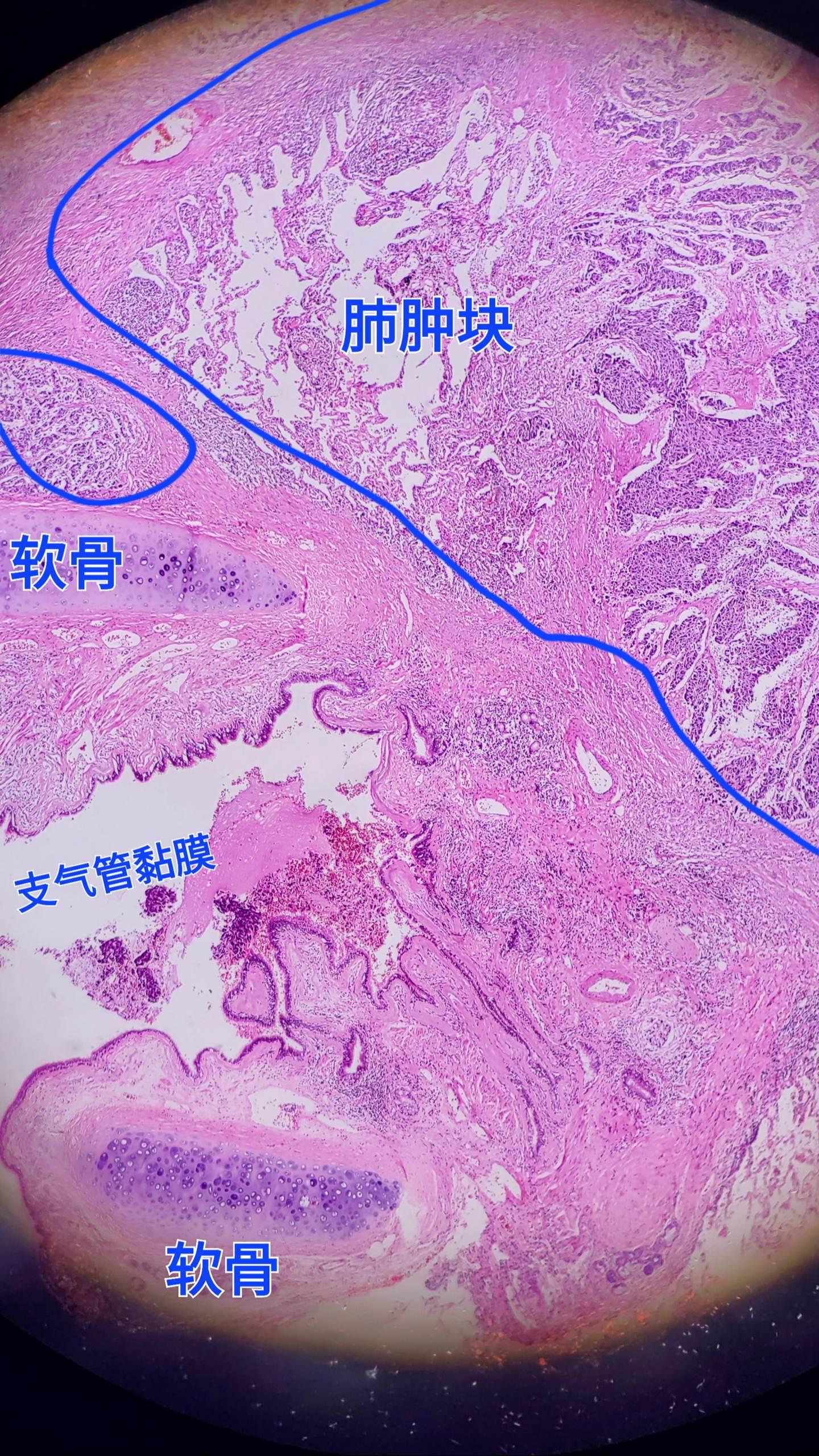 肺癌