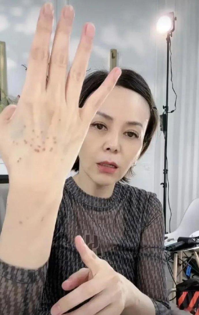 雪姨大方回应：老年斑  “雪姨”王琳大方承认自己手上以及胳膊上的斑点是“老年斑”