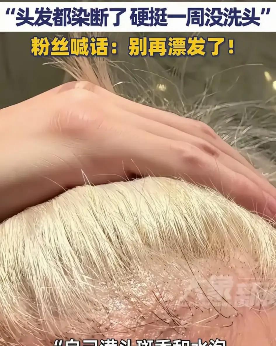 薛之谦重要演出前染发致满头斑秃水泡 年轻人频繁染发别踩坑
薛之谦发图吐槽染发后满