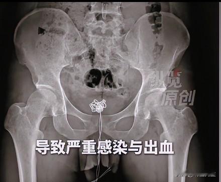 数据线为何能自行打结呢？

28岁男子一时好奇，把25厘米数据线塞进尿道，这下彻