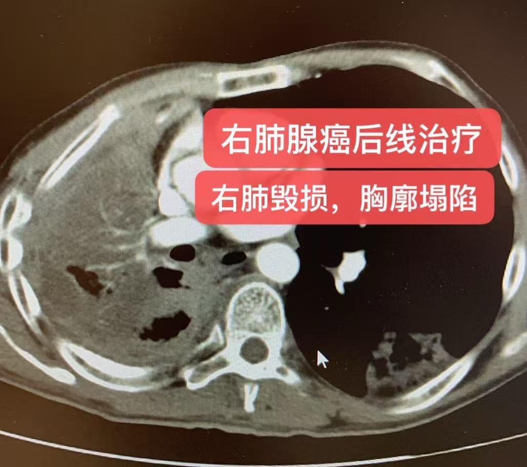 肺粘液腺癌后线治疗，基因检测阴性。男，50岁，基因检测阴性，骨转移等广...