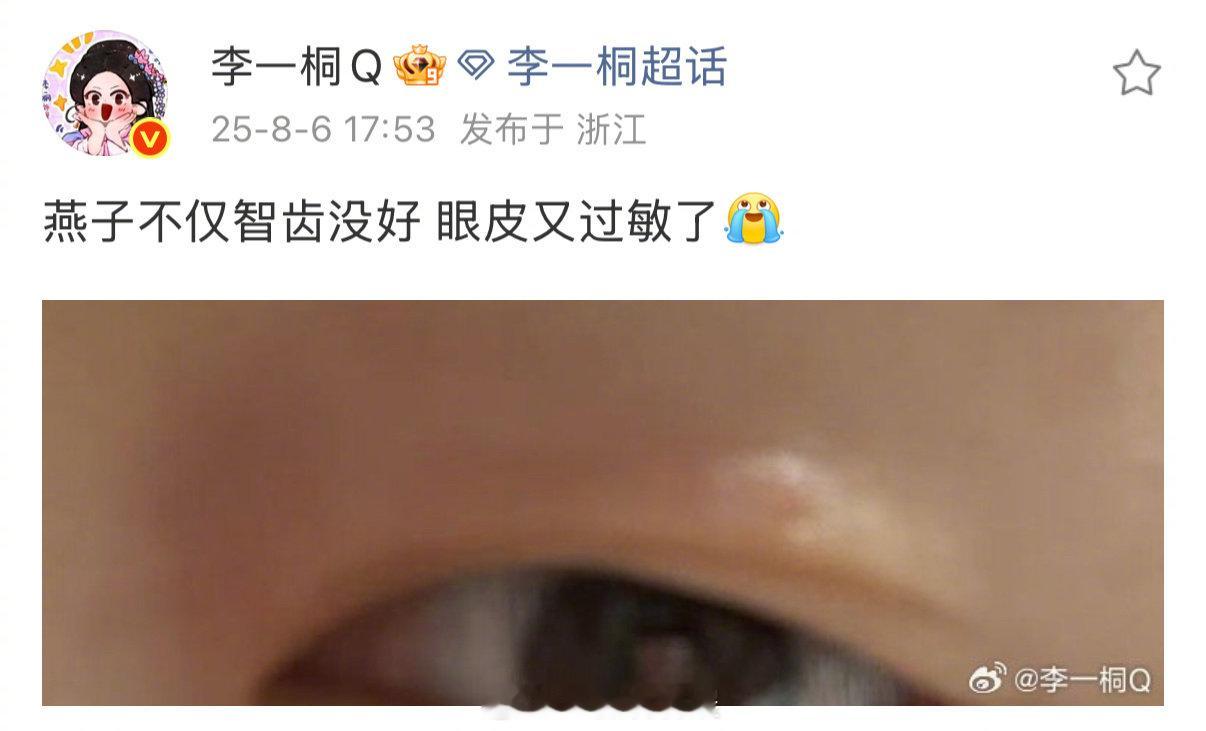 李一桐蜜蜂小狗预备役李一桐智齿没好眼皮又过敏了 近日，透露自己智齿没好眼皮又过敏