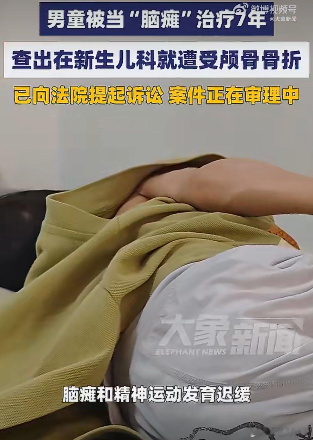 新生儿颅骨骨折医生诊断为脑积水2019年7月，男婴在广州南方医科大学珠江医院出生