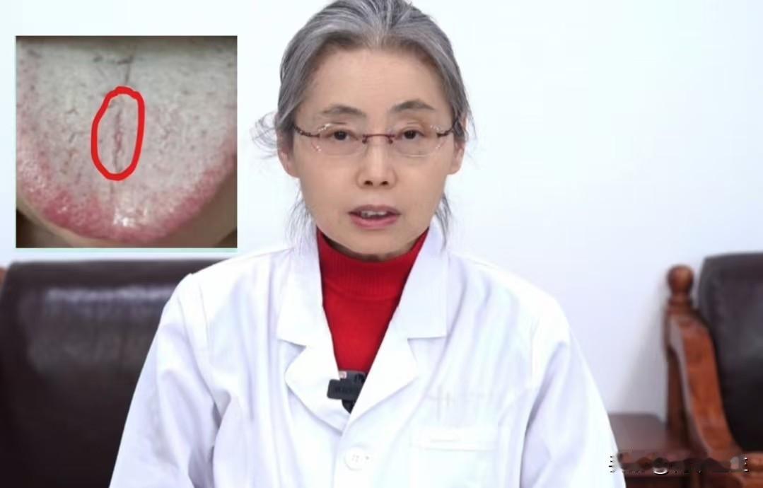 这种舌苔，主要病因不在肾，而在肝，调理不好真是折磨人

这个患者，今年33岁，出