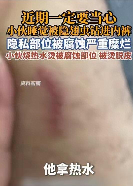 8月9日报道，浙江，一男子晚上睡觉的时候忘记了关窗户，一只隐翅虫飞了进来，好巧不