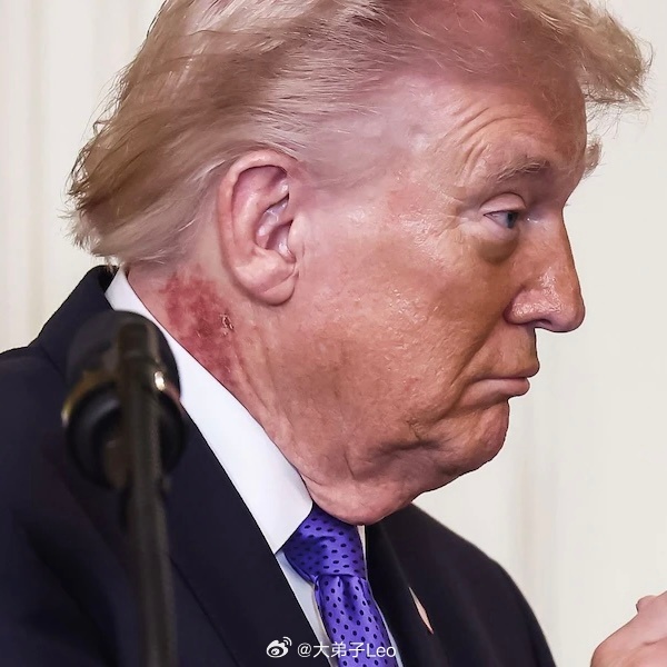 特朗普白宫举办活动被发现脖子上出现皮疹有没有医学朋友解释下热点现场