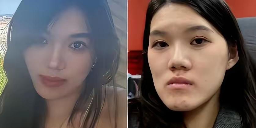 24岁的女孩做了正颌手术，想变美却成了毁容，原因：医生方向给做反了，脸越来越长，