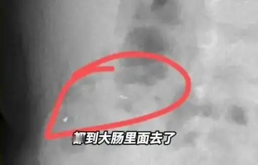 贵阳的刘女士1岁5个月大的儿子不小心把金锁上三个铃铛吞下了。
   吃进肚子里会