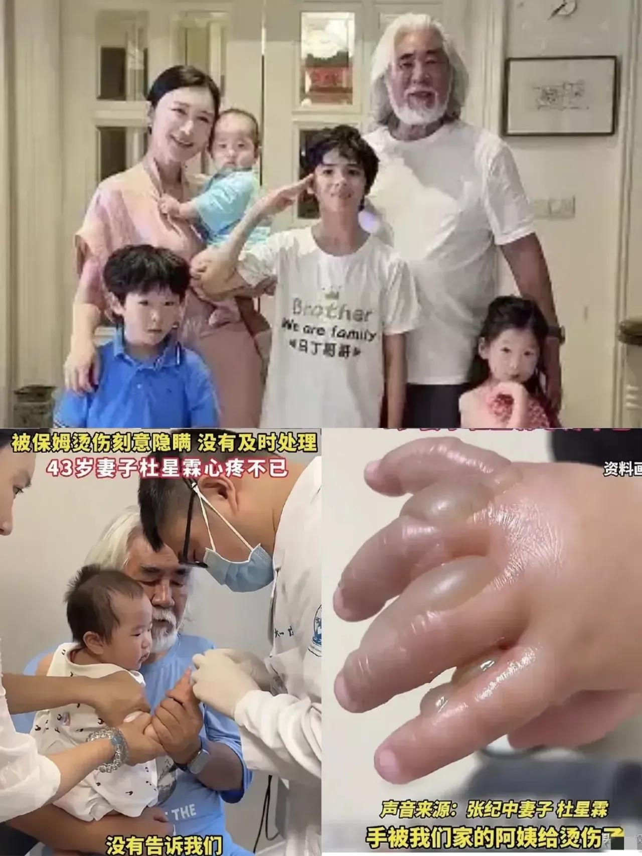 张纪中9个月的小女儿被保姆烫伤！看着9个月宝宝手上的那个烫伤水泡，看着她哭的撕心