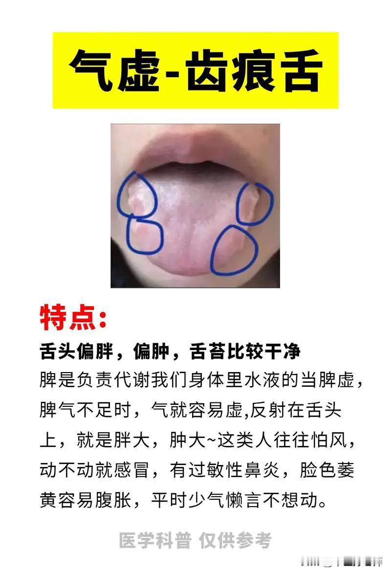 4种不同的齿痕舌，看看你是哪种？#健康##舌象分析#