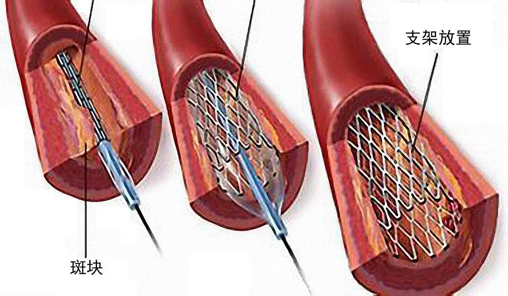 心脏支架能用几年？
今天一位大爷出院时问我：“大夫，这前天做的心脏支架在里面能用