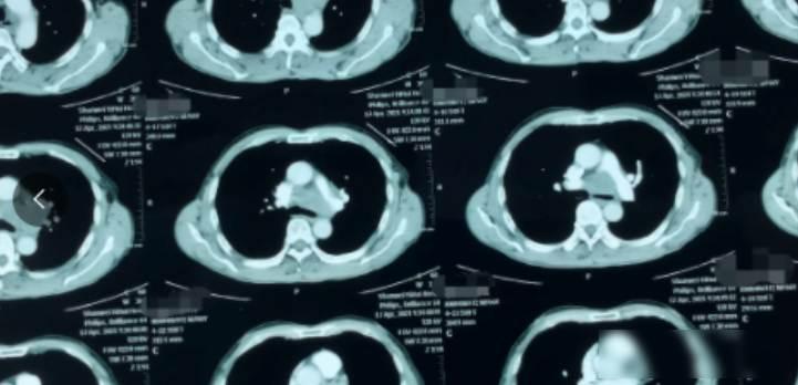 患者半年前 CT 体检完全正常，仅仅半年后再检查，就已是肺癌晚期。


半年前体