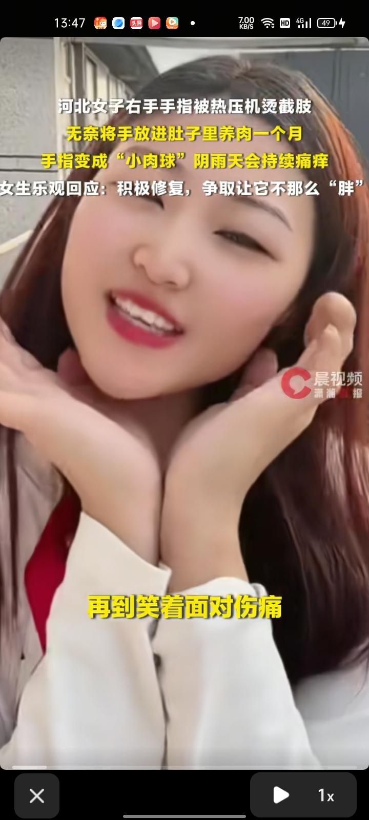 近日，河北沧州。女子晒出“小肉球”手指引发网友关注，从失去手指到“种”指求生，再