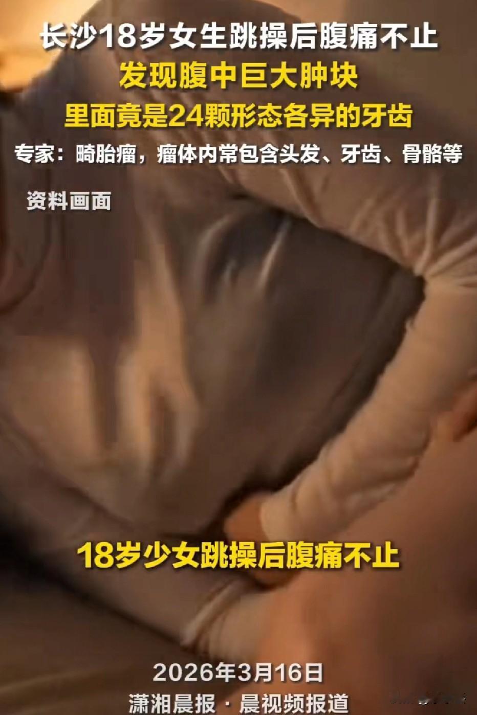 18岁姑娘跳完操疼得直不起腰，肚子里竟掏出24颗牙…看完我后背发凉
 
长沙这个