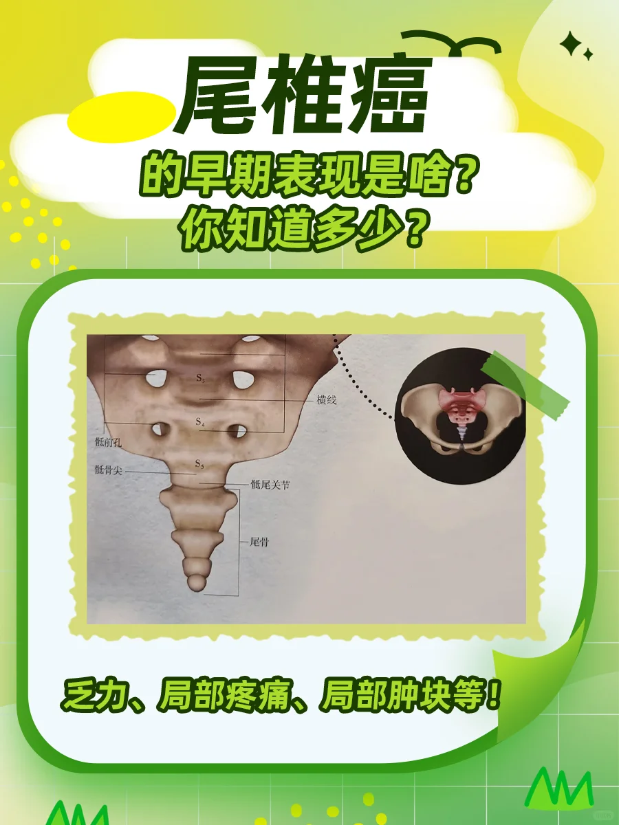 尾椎癌的早期表现