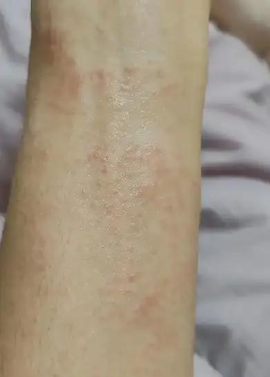 一条“腿痒”拖成“树皮”！28岁程序员差点截肢：你以为的湿疹，可能是身体在拉响红