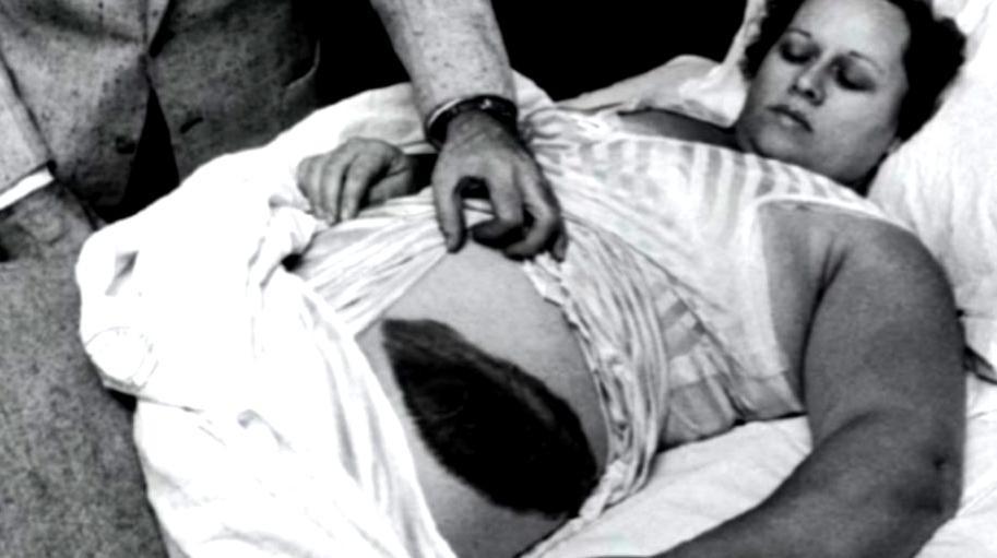 1954年，一名国外女子正在睡梦之中，忽然感到腹部与大腿传来一阵灼痛，仿佛被什么