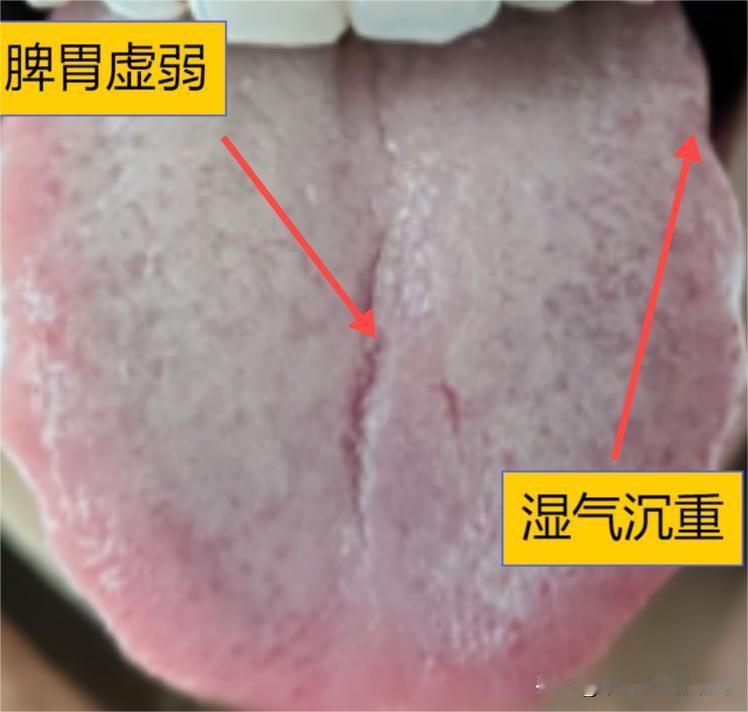 这种裂纹舌，一定要看清楚再去调理！否则就会跟他一样，越补反而越上火
舌头两边有牙