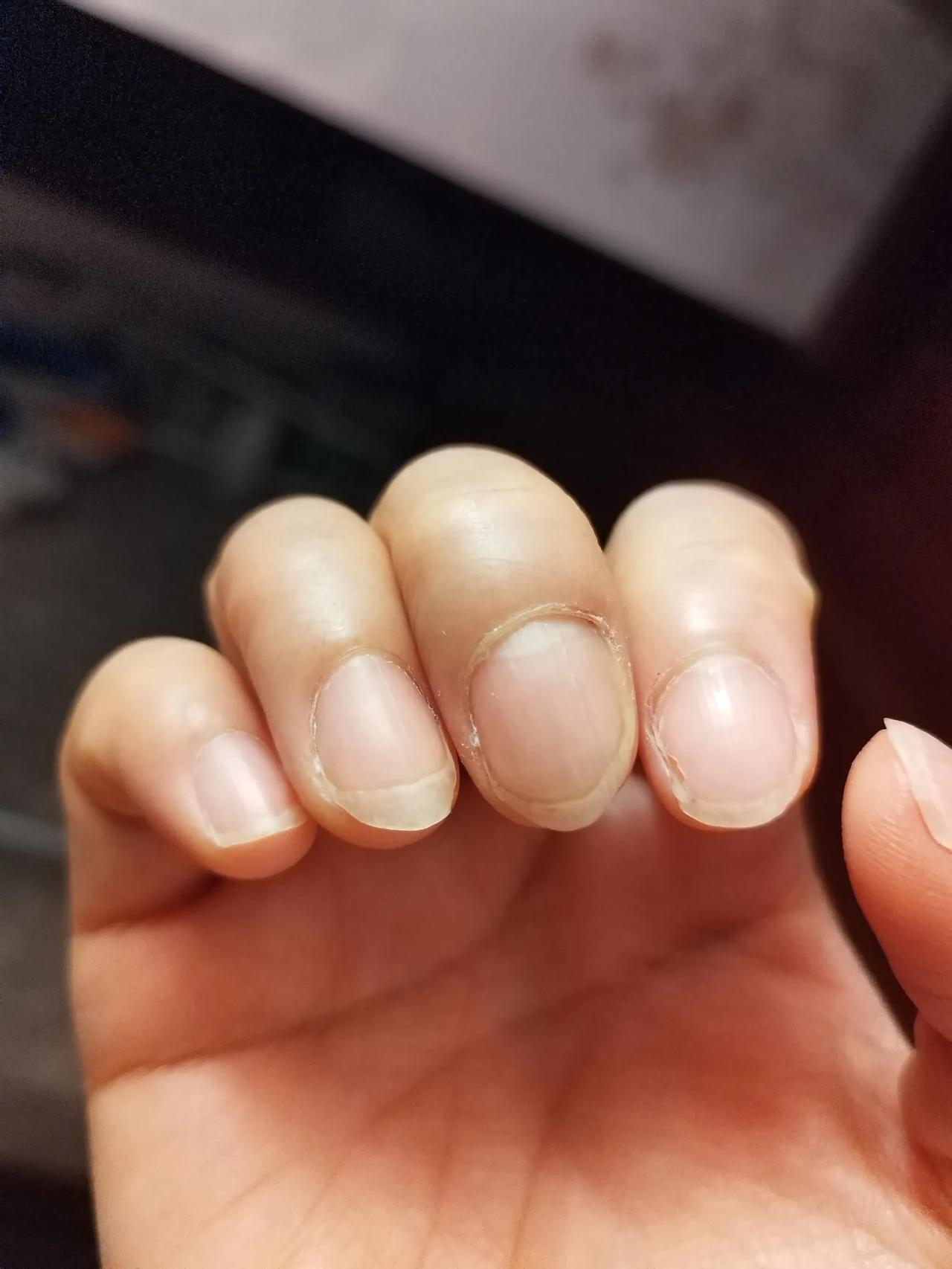 一次辛苦劳动治好了我的灰指甲。
我的右手中指有个灰指甲，已经陪伴了我二十多年了，