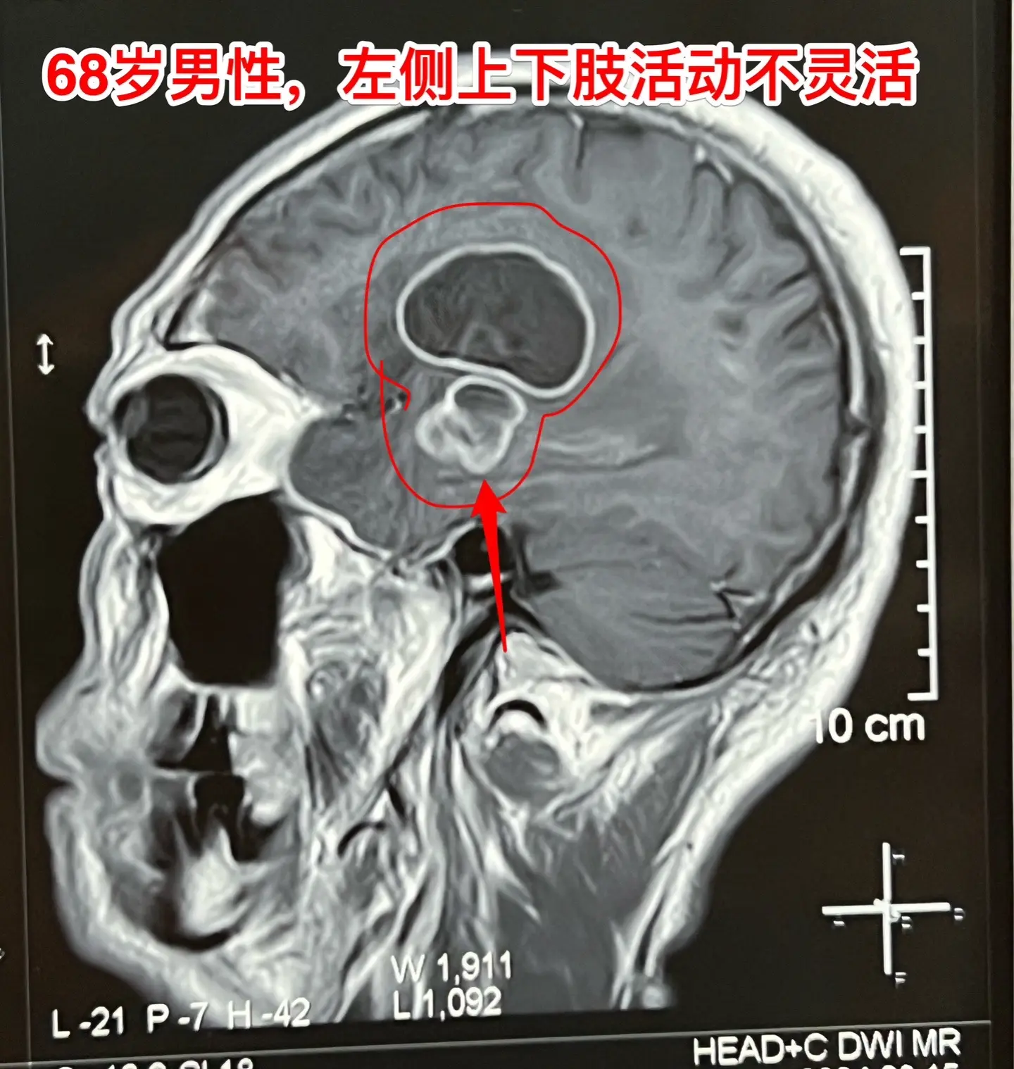 老人擀饺子皮的质量下降了，原因是什么？68岁的唐山市老人，擅长擀饺子皮...