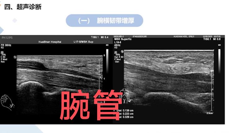 腕管超声。正中神经受压